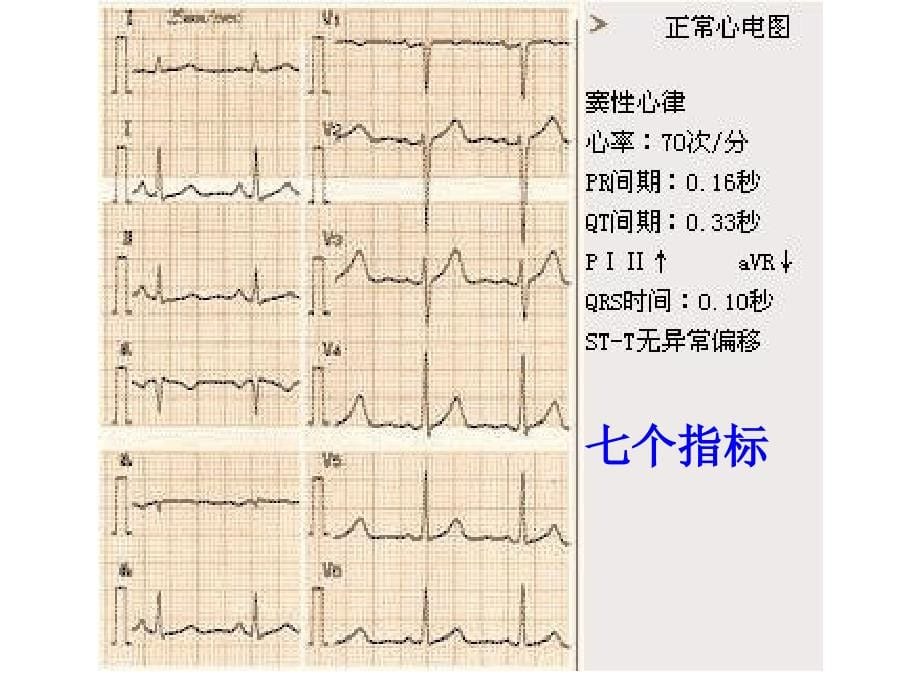 心电图4教学幻灯片_第5页