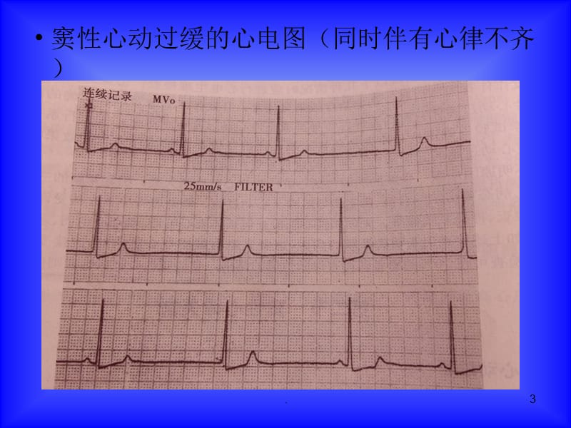 窦性心动过缓病因分析PPT课件_第3页