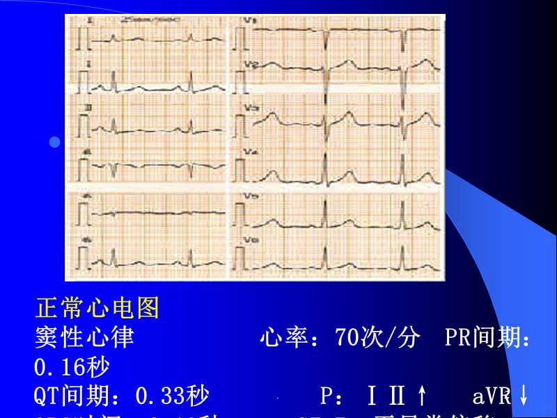 术中常见心律失常的诊断及处理PPT课件_第2页