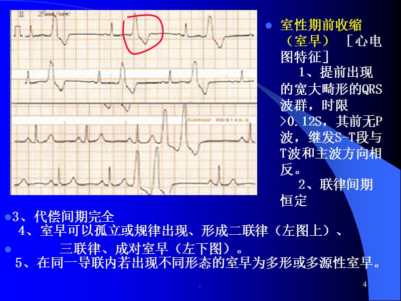 术中常见心律失常的诊断及处理PPT课件_第4页