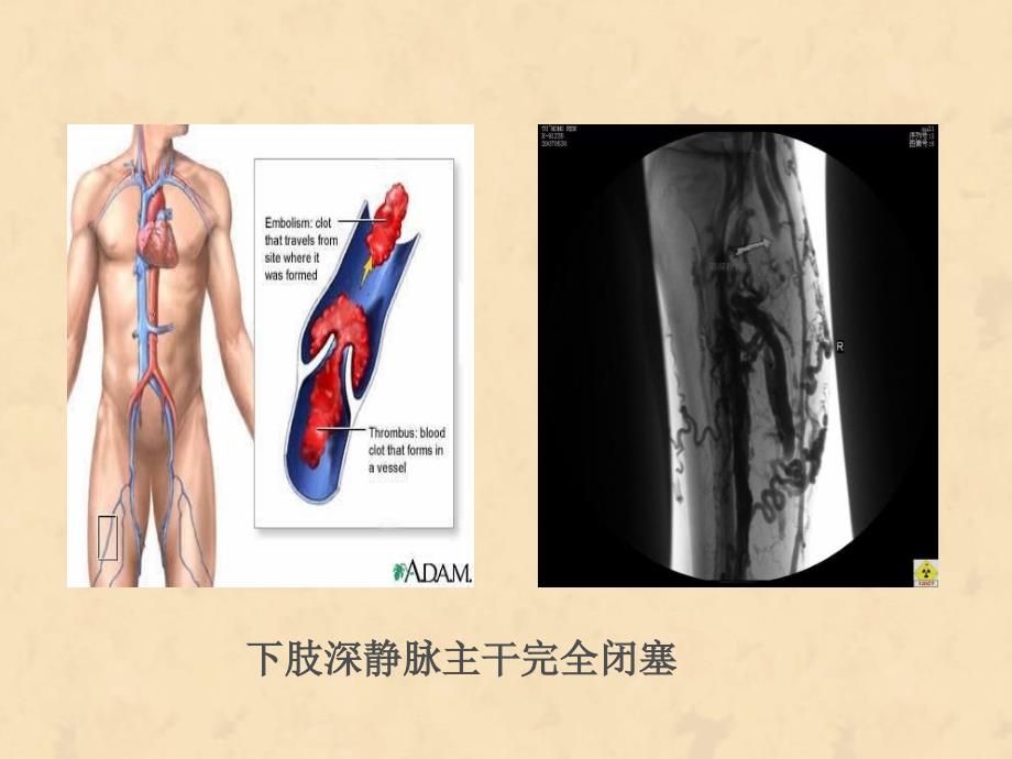 下肢静脉血栓的相和关知识护理培训讲学_第3页