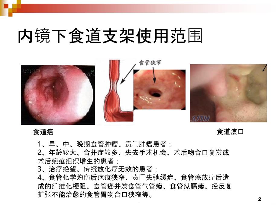 食道支架PPT课件_第2页