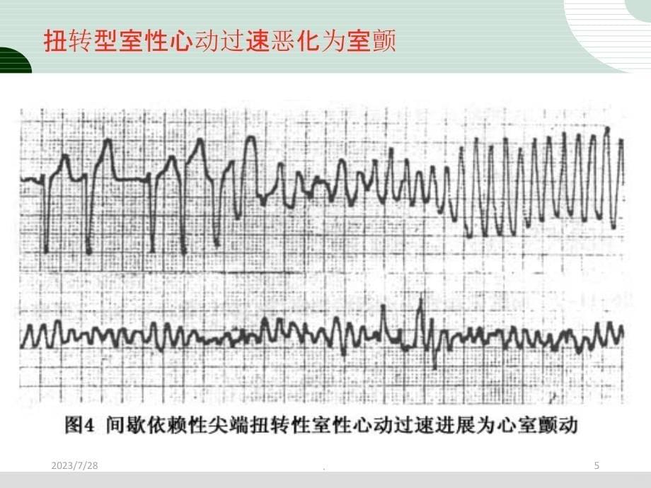 扭转型室性心动过速PPT课件_第5页