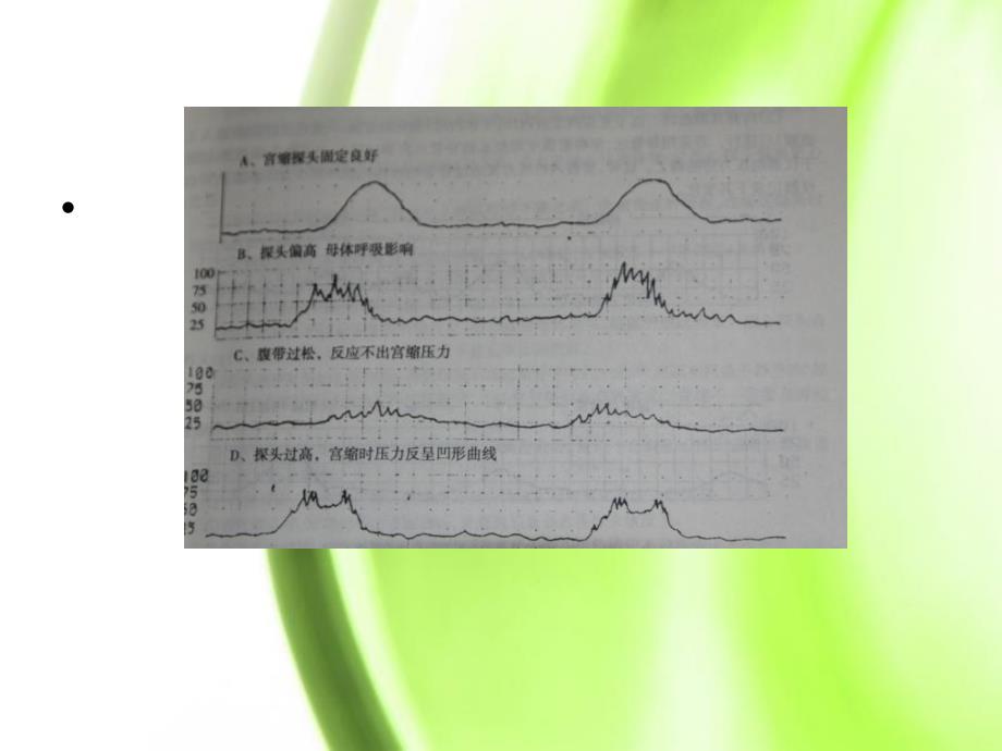 胎心监护王俊英培训资料_第3页