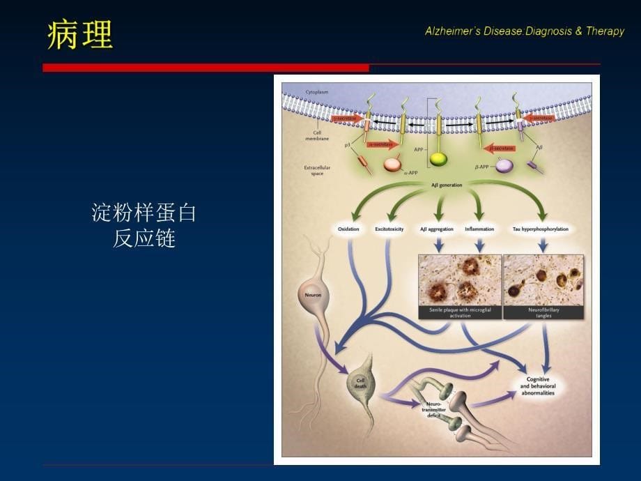 【老年基础医学学习资料】_老年神经系统疾病_20200425234131_第5页