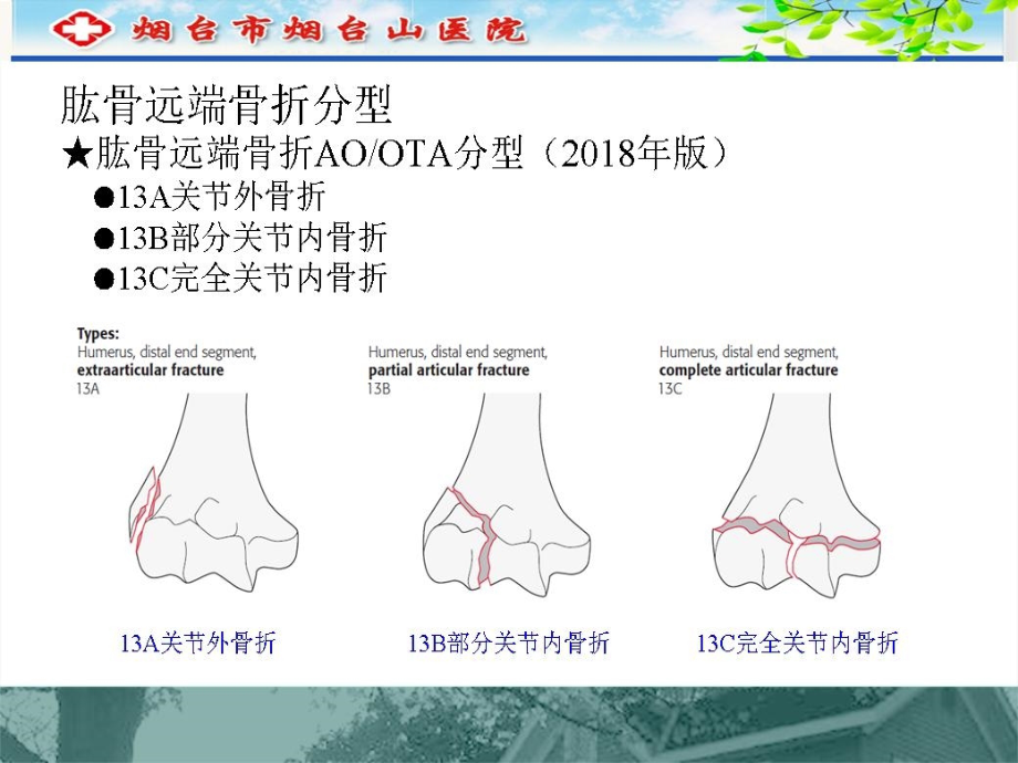 肱骨远端C型骨折的手术入路_第4页