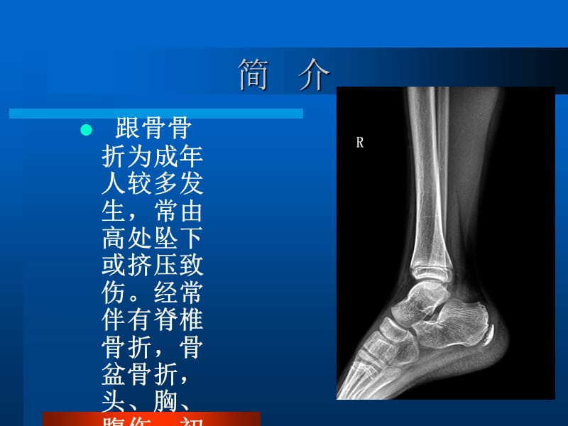 跟骨骨折患者的护理查房_第3页