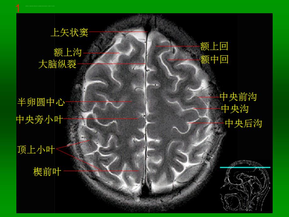 颅脑MRI断层解剖与影像课件_第2页
