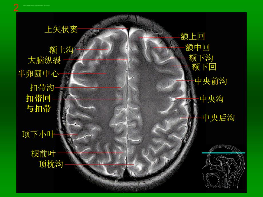 颅脑MRI断层解剖与影像课件_第4页