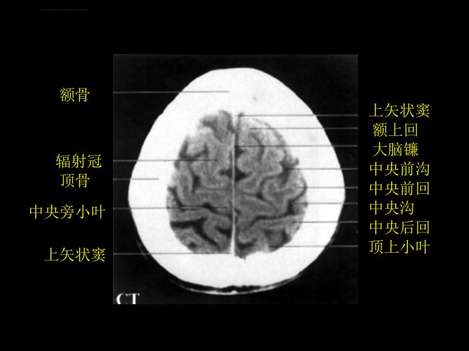 颅脑正常CT和MRI课件_第1页