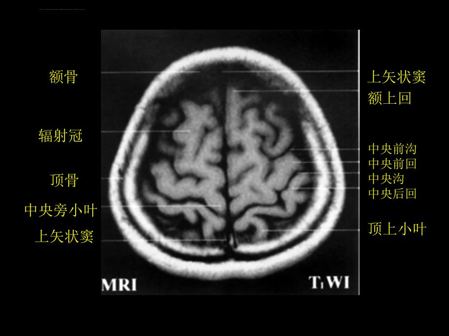 颅脑正常CT和MRI课件_第2页