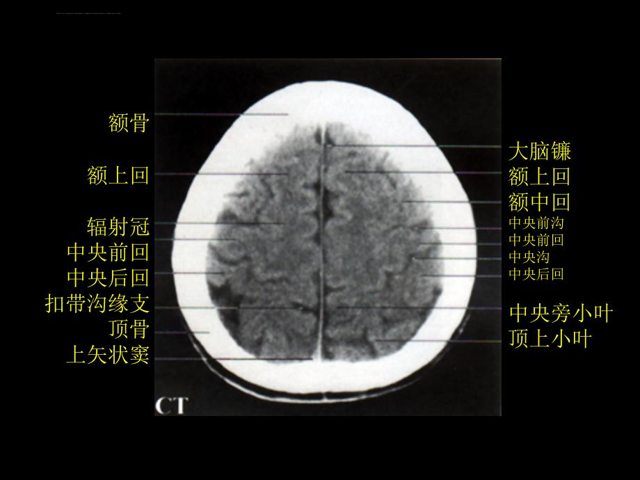颅脑正常CT和MRI课件_第3页