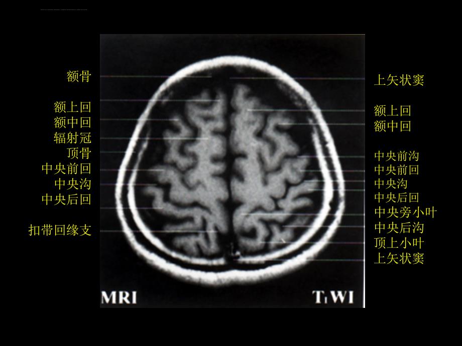 颅脑正常CT和MRI课件_第4页