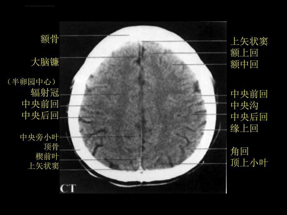 颅脑正常CT和MRI课件_第5页