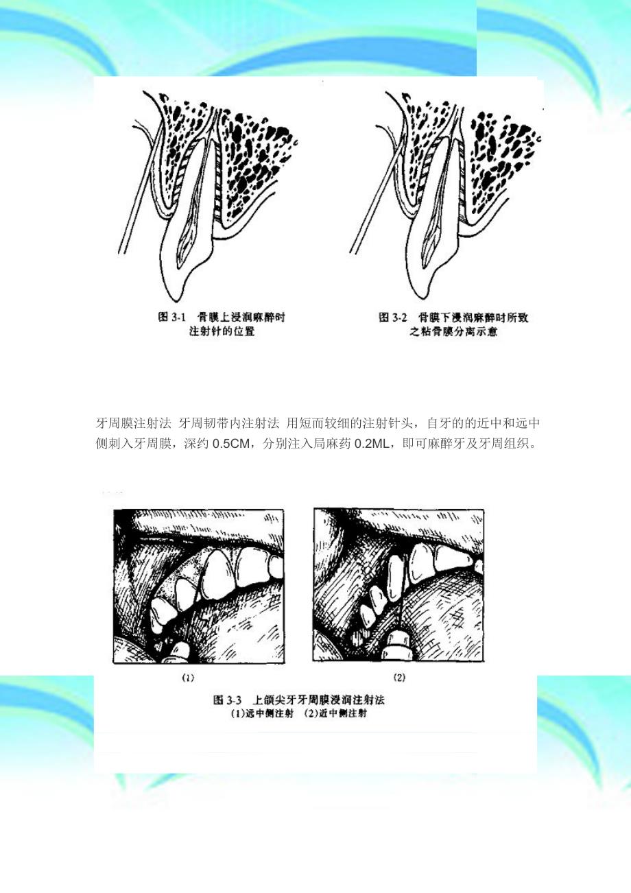 口腔颌面外科门诊系列讲座—麻醉_第4页