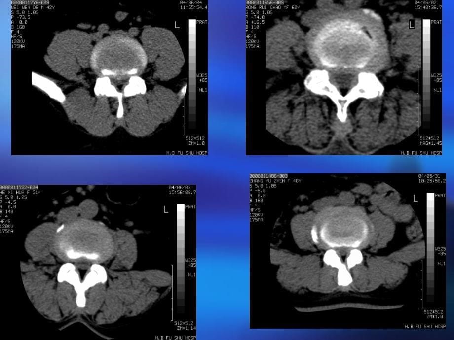 脊柱CTMRI诊断_第5页