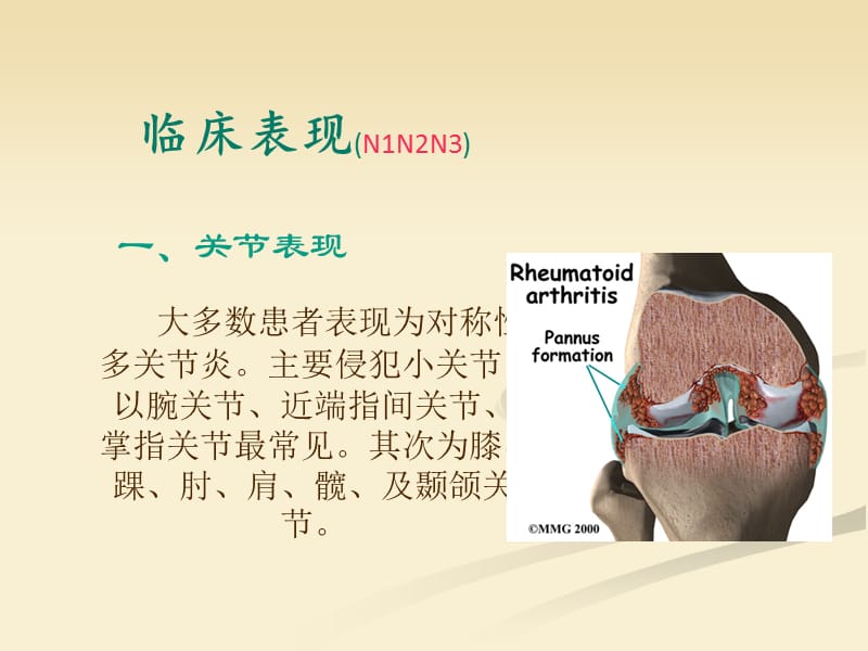 类风湿性关节炎护理查房82257_第5页