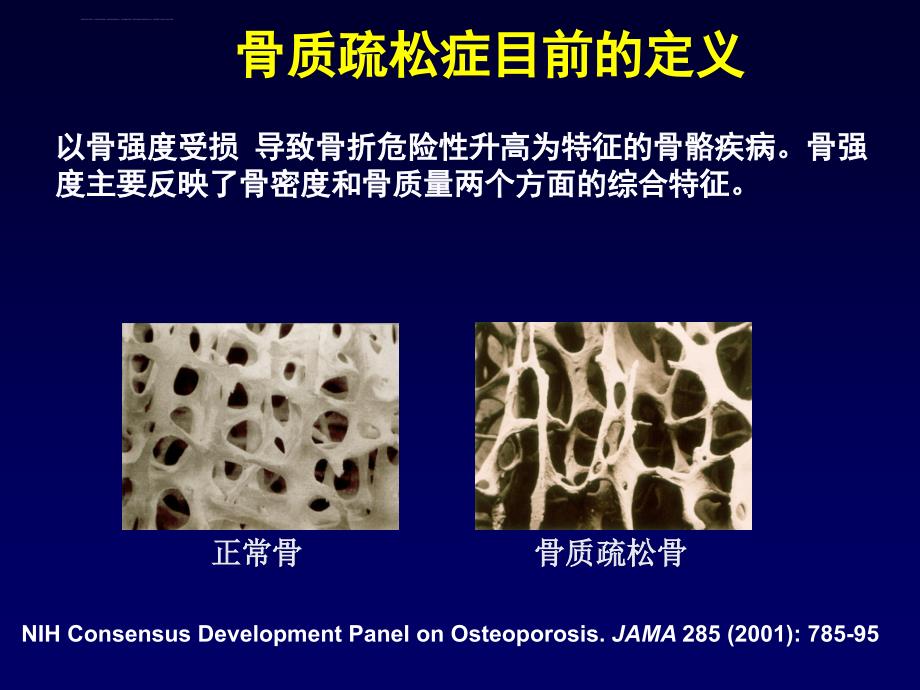 骨质疏松症的诊断与治疗 北京协和医院课件_第2页