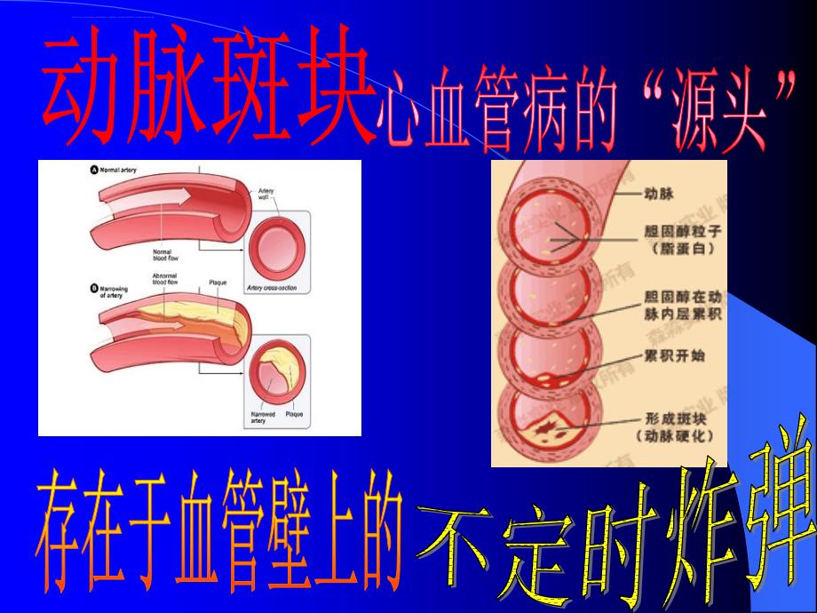 颈动脉斑块专题课件_第1页