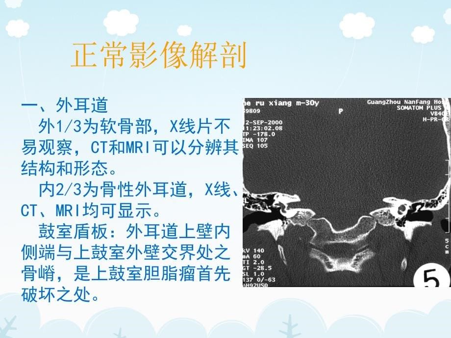 医学影像-耳的影像解剖及常见疾病诊断精品课件_第5页