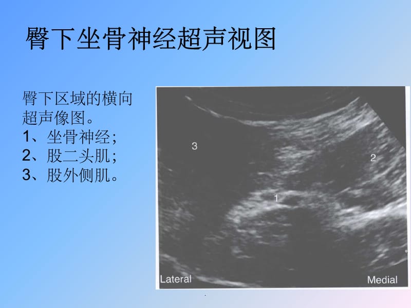 坐骨神经阻滞ppt课件_第5页