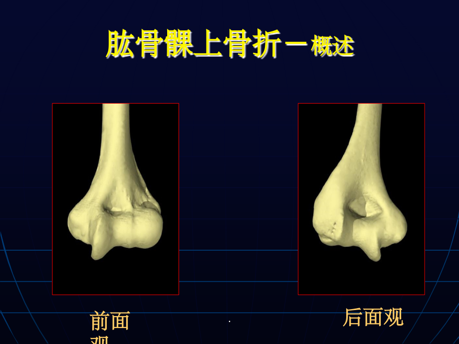 肱骨髁上、外髁、内上髁骨折ppt课件_第3页