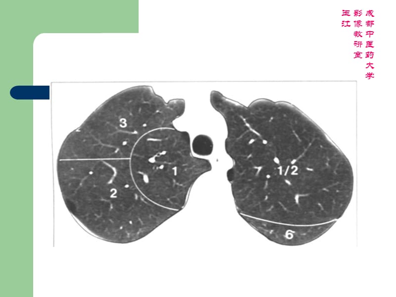 胸部CT肺窗：肺叶、肺段_第2页