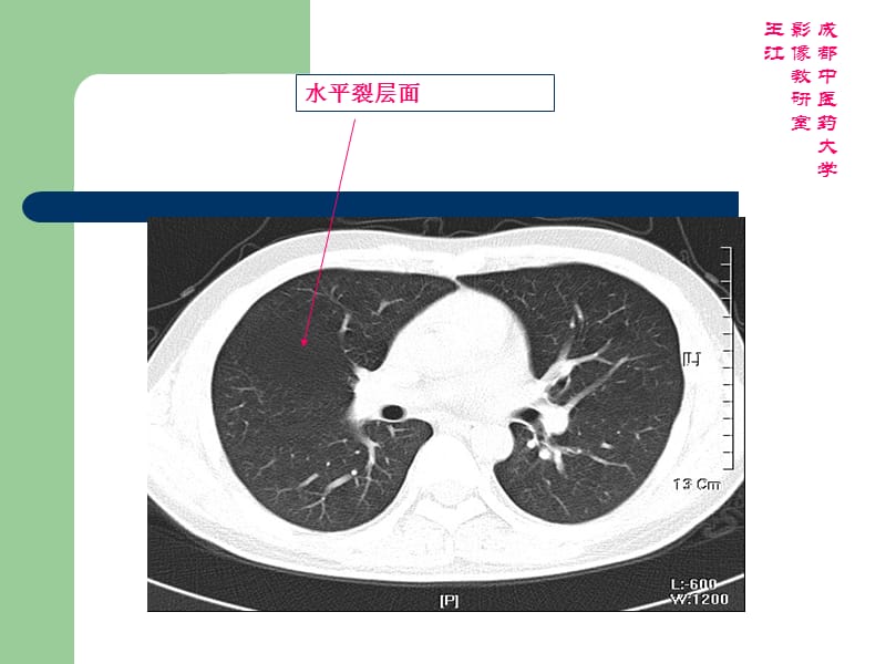 胸部CT肺窗：肺叶、肺段_第5页