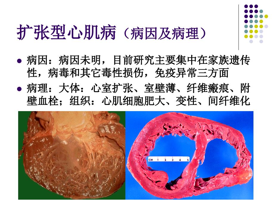 内科学PPT课件 心肌病 心肌疾病 扩张型肥厚型限制型心肌病 循环系统疾病 心脑血管疾病_第4页