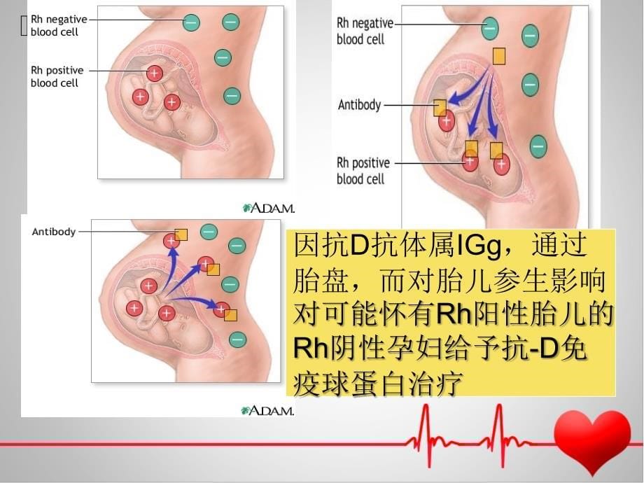 Rh(-)血型科学输血课件_第5页