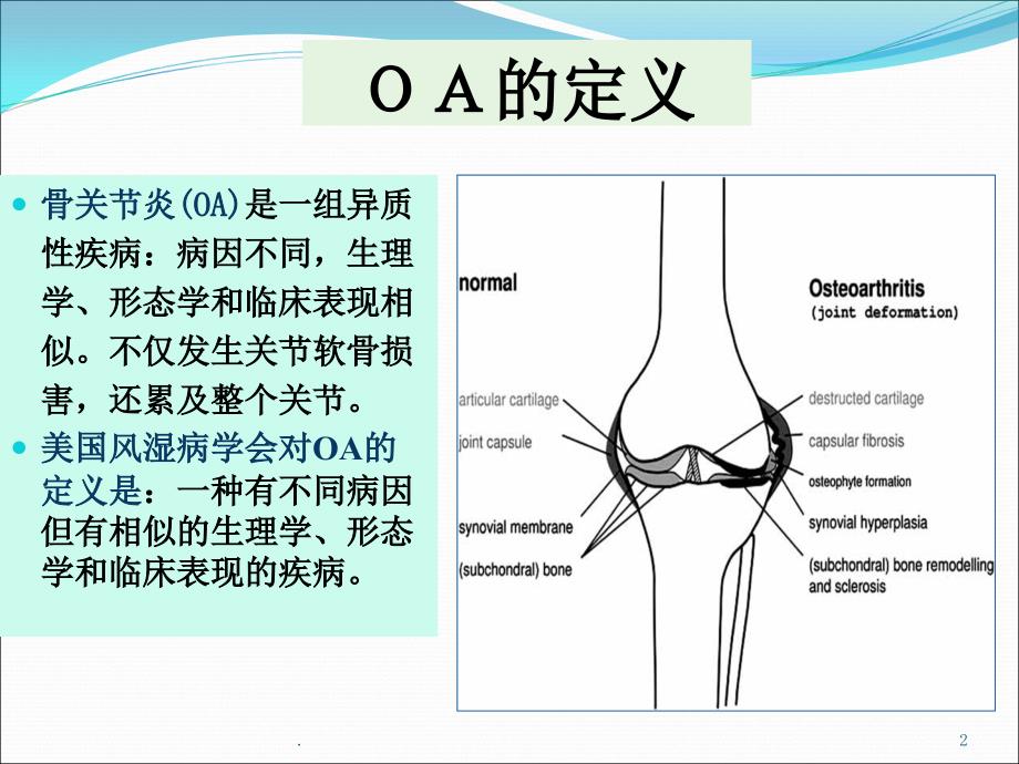 骨关节炎-最新ppt课件_第2页