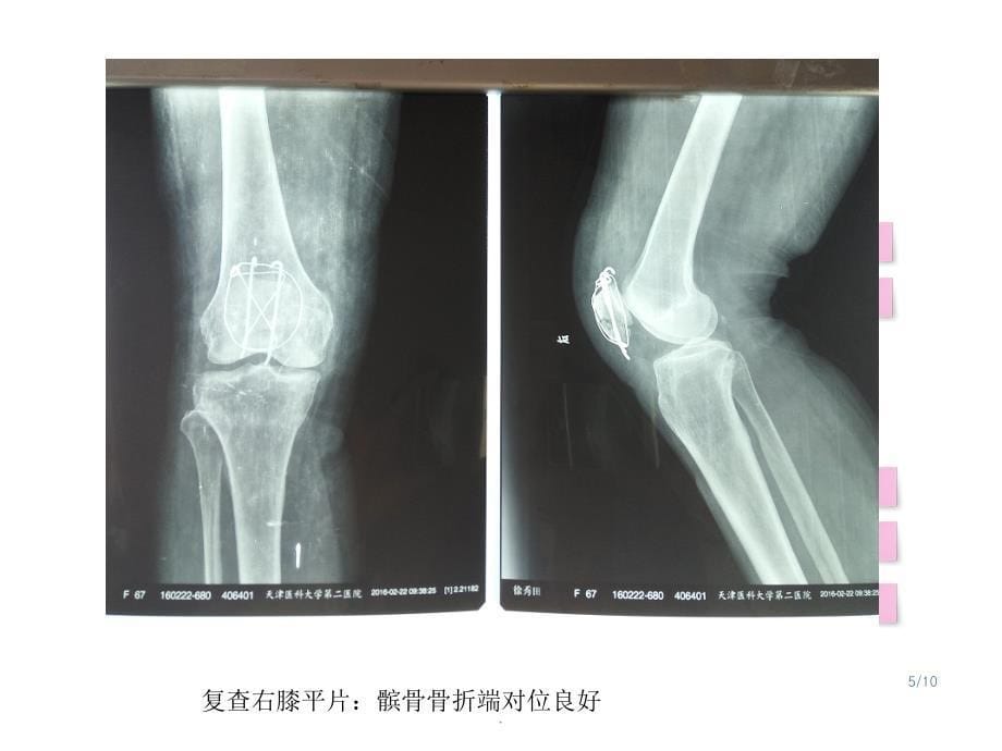 骨科经典病例最新版本ppt课件_第5页