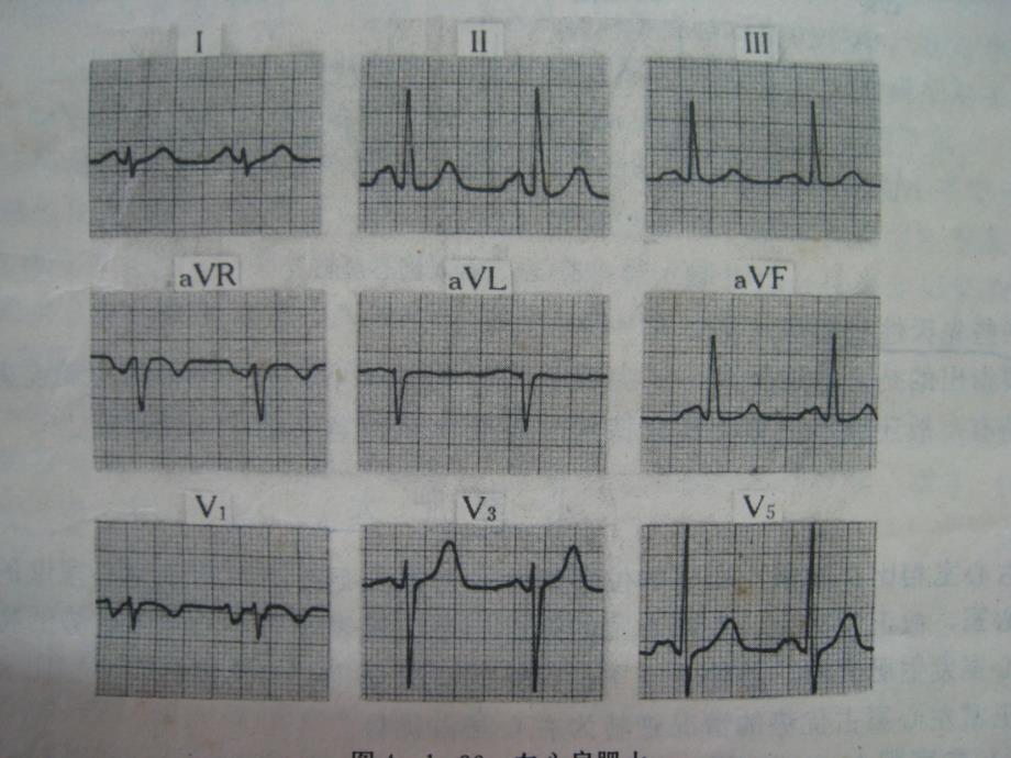 《看识心电图》ppt课件_第3页
