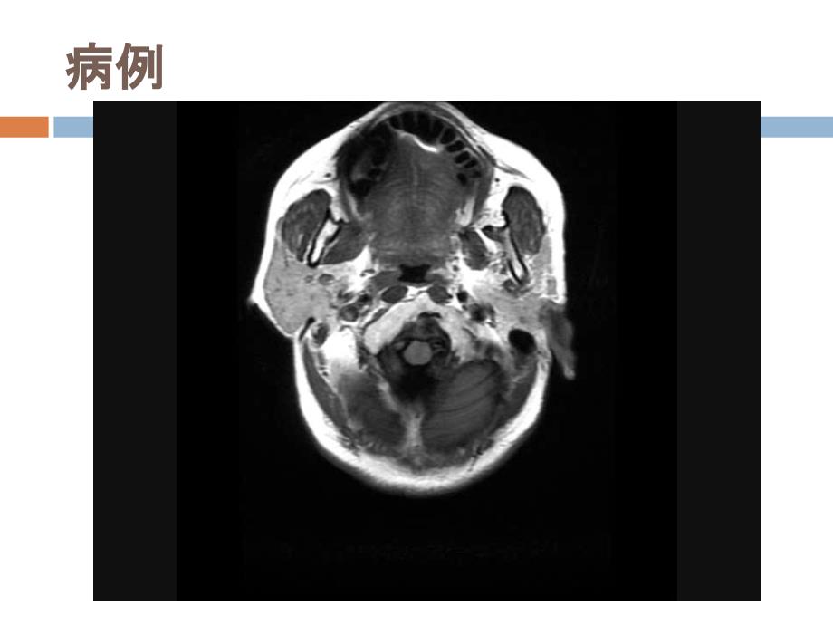 三叉神经鞘瘤-精选文档课件_第1页