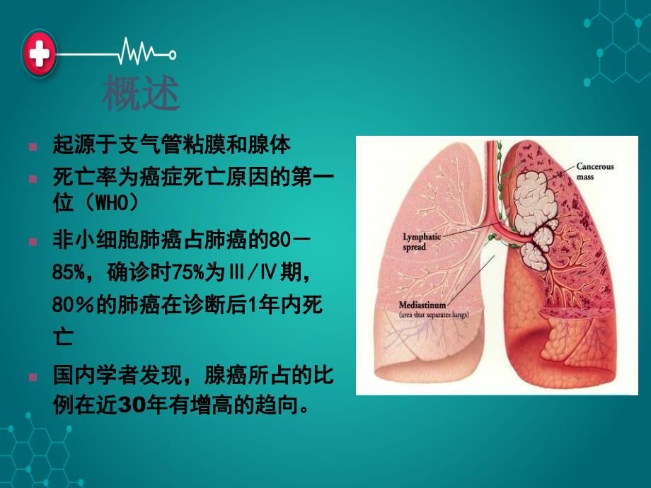 原发性支气管肺癌1ppt课件_第2页