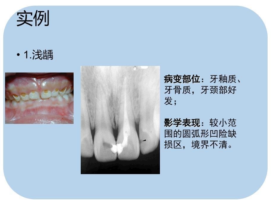 影像学.牙.牙周.颌骨.肿瘤样疾病ppt课件_第5页