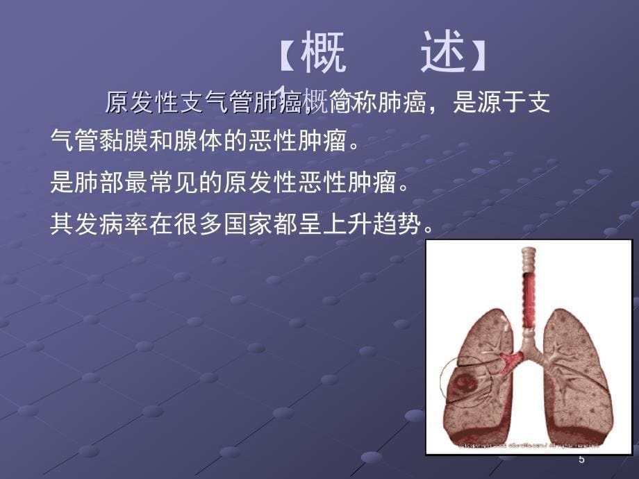 原发性支气管肺癌讲述ppt课件_第5页