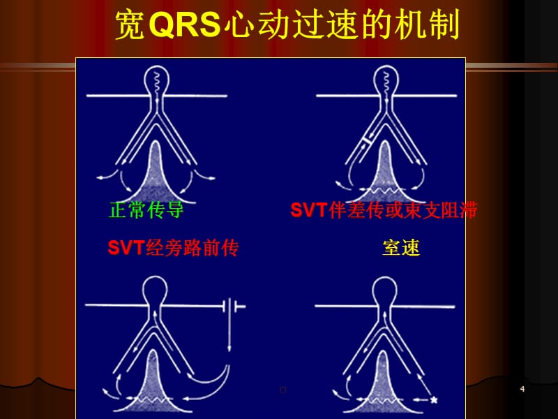 {企业管理诊断}宽QRS心动过速的鉴别诊断_第4页