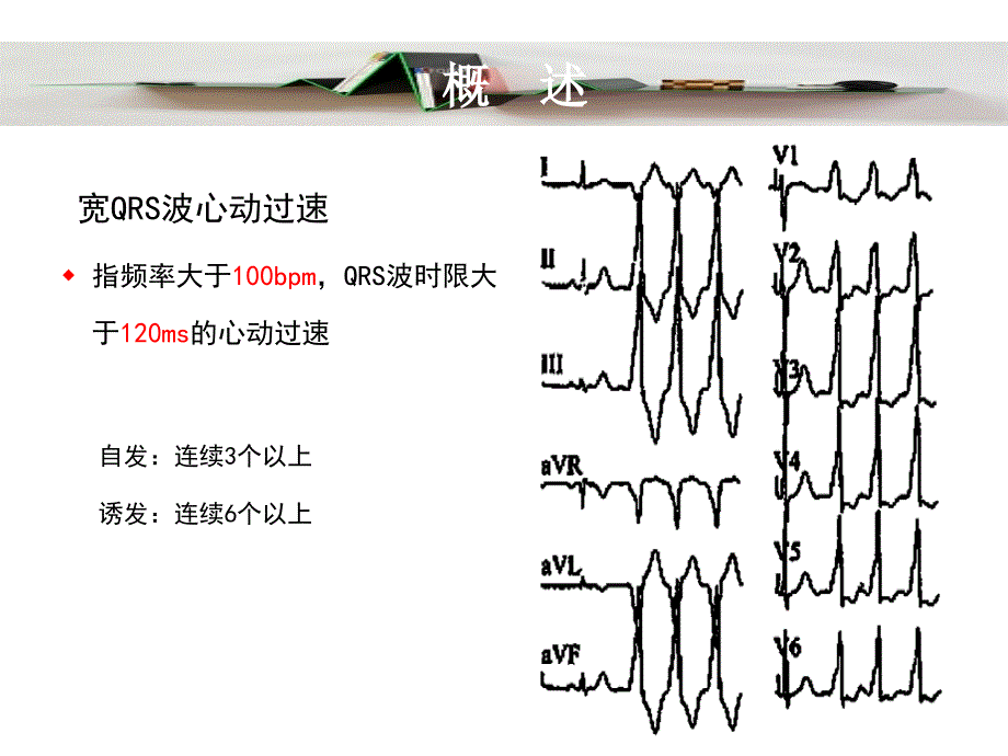 {企业管理诊断}宽QRS波群心动过速鉴别诊断新思路_第3页