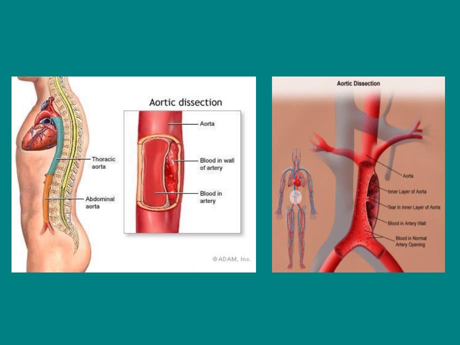主动脉夹层动脉瘤课件ppt课件_第4页