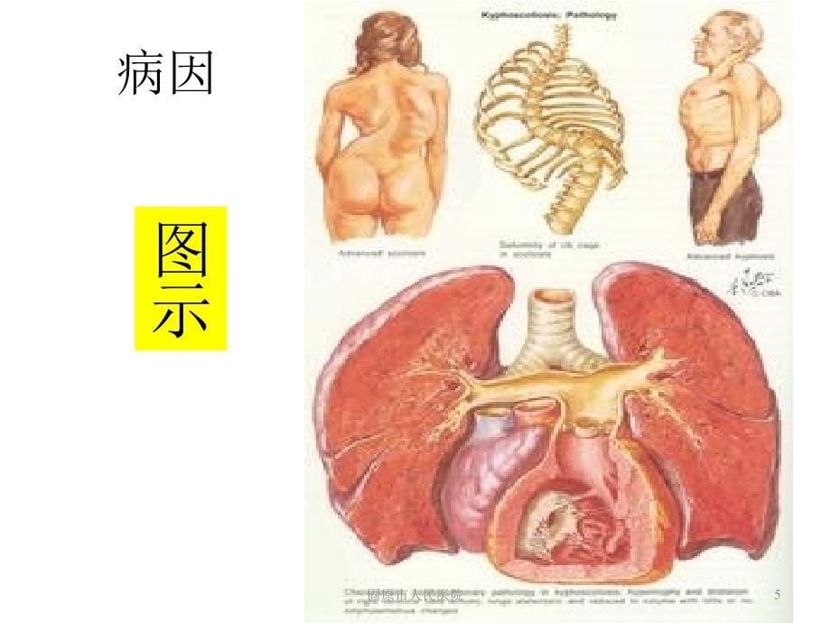 最新慢性肺源性心脏病精品课件_第5页