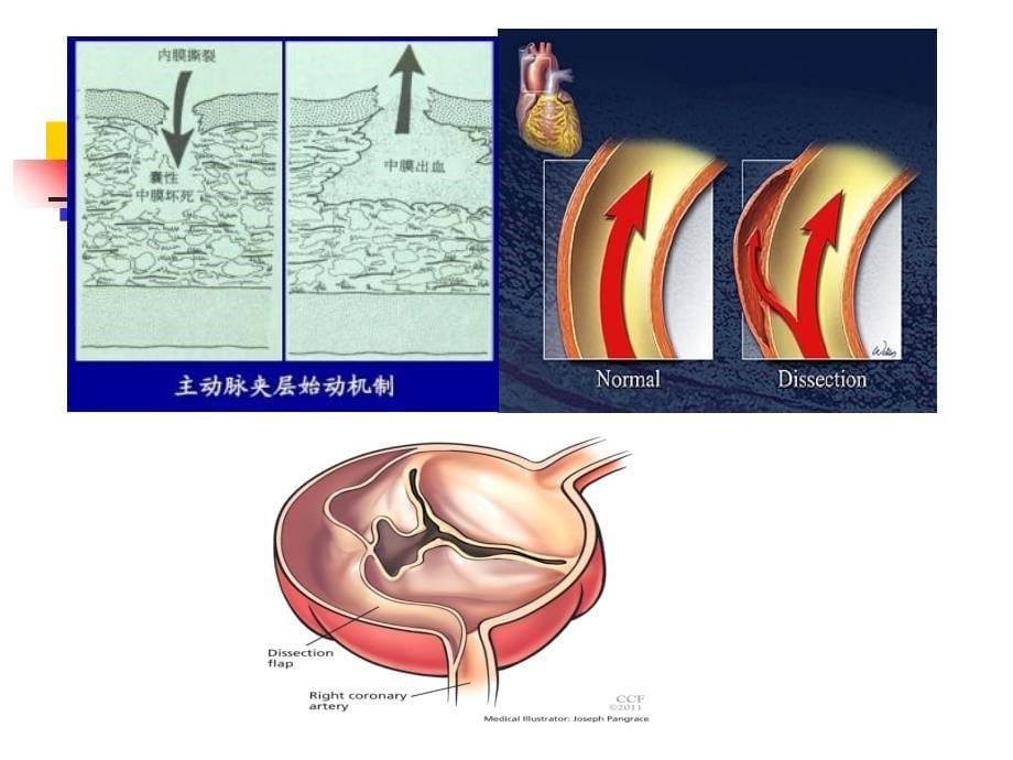 主动脉夹层的早期诊断与治疗课件_第5页