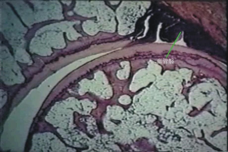 类风湿关节炎教学幻灯片_第5页