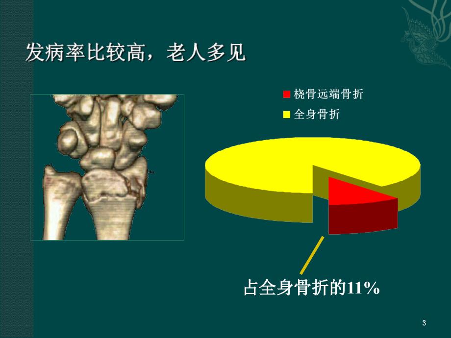 桡骨远端骨折（课堂PPT）_第3页