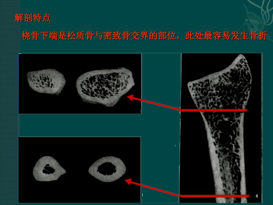 桡骨远端骨折（课堂PPT）_第4页