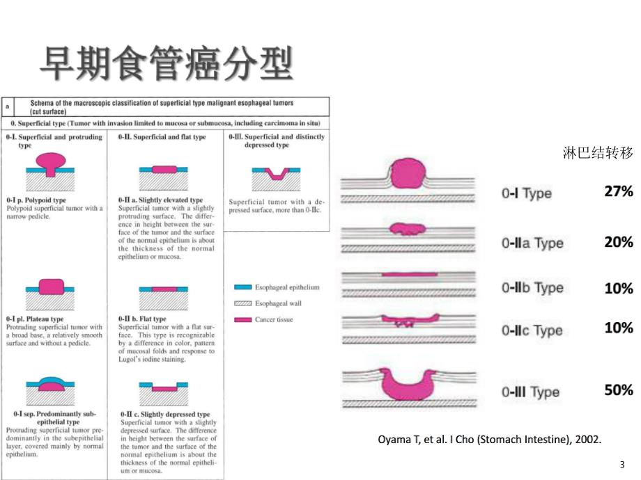 NBI+放大在食管早癌诊断中的应用进展演示PPT_第3页