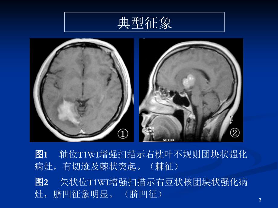脑部原发性淋巴瘤的MRI诊断（课堂PPT）_第3页