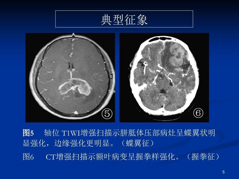 脑部原发性淋巴瘤的MRI诊断（课堂PPT）_第5页