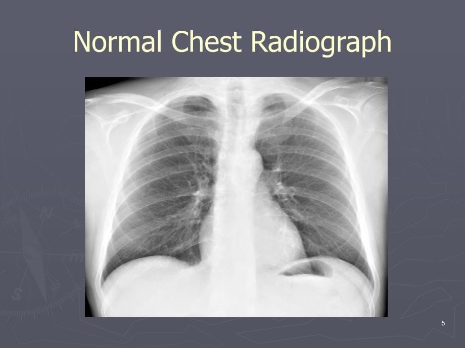 CXR Interpretation胸部医学影像解读演示PPT_第5页