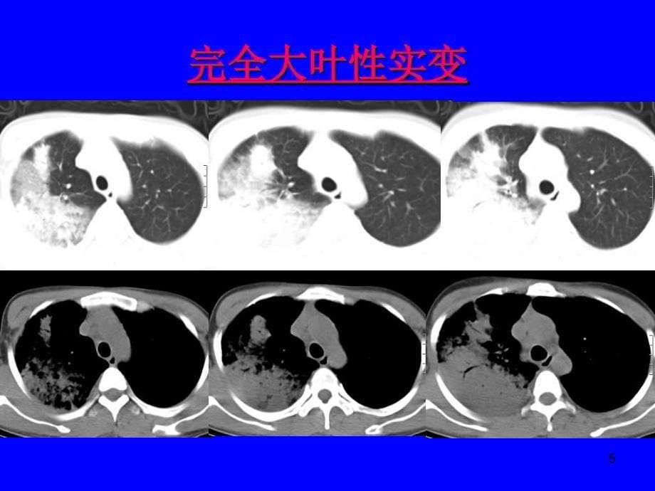 肺炎的影像学诊断（课堂PPT）_第5页